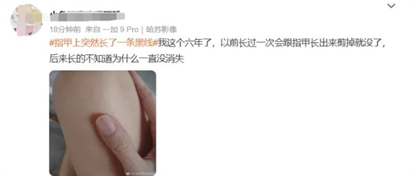 指甲出現(xiàn)一條黑線 別不當(dāng)回事！可能是癌變