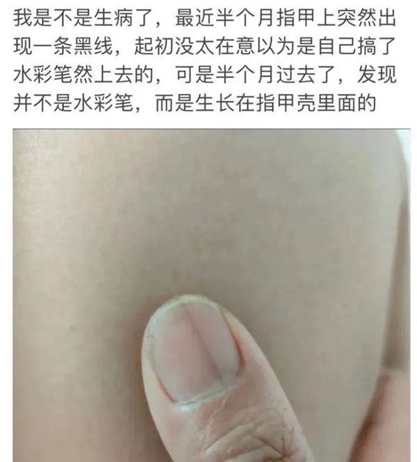 指甲出現(xiàn)一條黑線 別不當(dāng)回事！可能是癌變