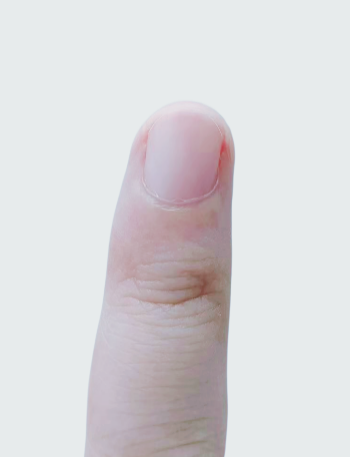 指甲出現(xiàn)一條黑線 別不當(dāng)回事！可能是癌變