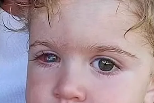 1歲多寶寶疑被大人親吻后失明 醫(yī)生：感染皰疹病毒致眼角膜穿孔